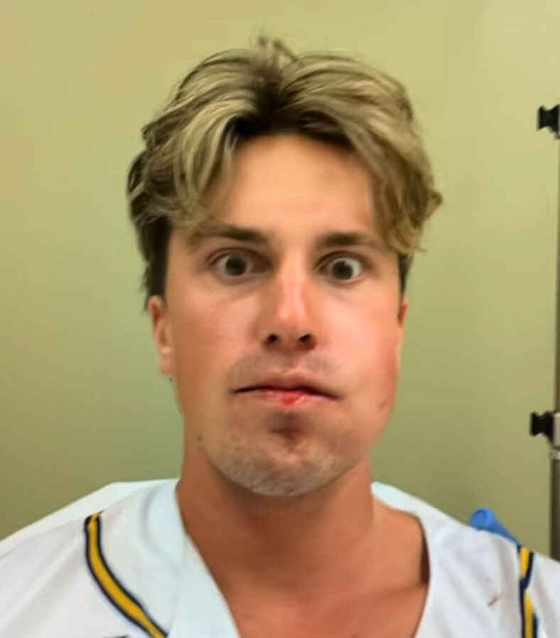 Jackson Olson selfie image after baseball injury to jaw